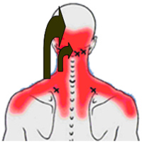 cervikokraniálny syndróm - schéma svalových spazmov