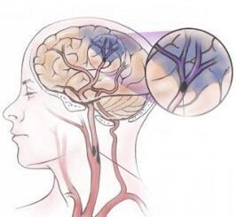 upchaté cievy v mozgu - ischémia