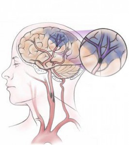 upchaté cievy v mozgu - ischémia