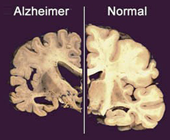Mozog pacienta s Alzheimerovou chorobou