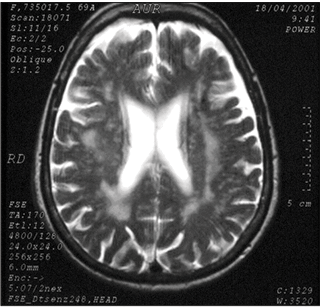 vaskulárny parkinsonizmus - magnetická rezonancia