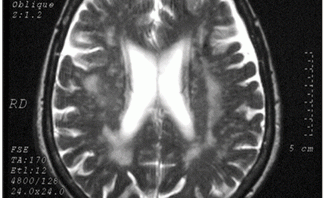 vaskulárny parkinsonizmus - magnetická rezonancia