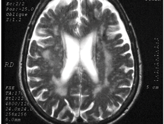vaskulárny parkinsonizmus - magnetická rezonancia