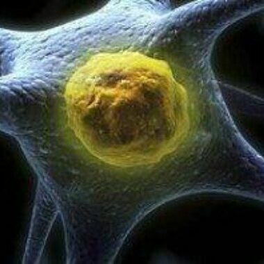 Cievna mozgová príhoda