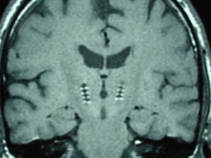elektrody Parkinsonova choroba - zavedené elekródy hlbokej mozgovej stimulácie
