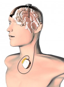 dbs schema schéma neurostimulátora