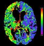 prekrvenie mozgu zobrazené na CT