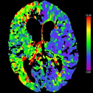 prekrvenie mozgu zobrazené na CT