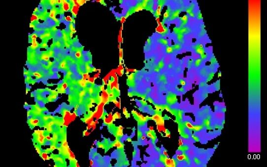 prekrvenie mozgu zobrazené na CT