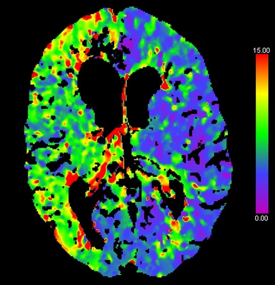 prekrvenie mozgu zobrazené na CT